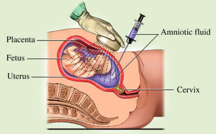 Amniocentesis & CVS