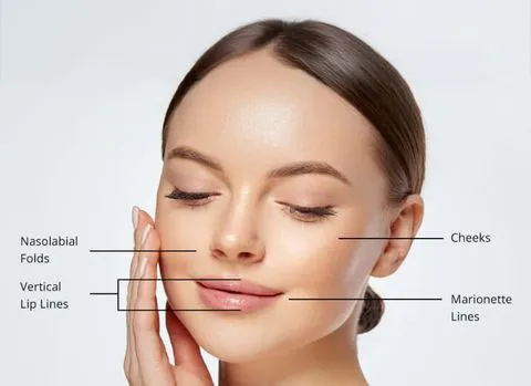 Diagram of a woman's face labeling facial treatment areas: Cheeks, Nasolabial Folds, Vertical Lip Lines, and Marionette Lines