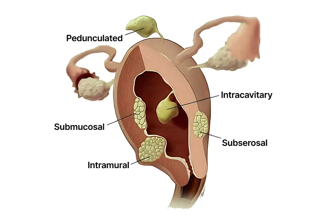 Uterine Fibroids Treatment In Singapore