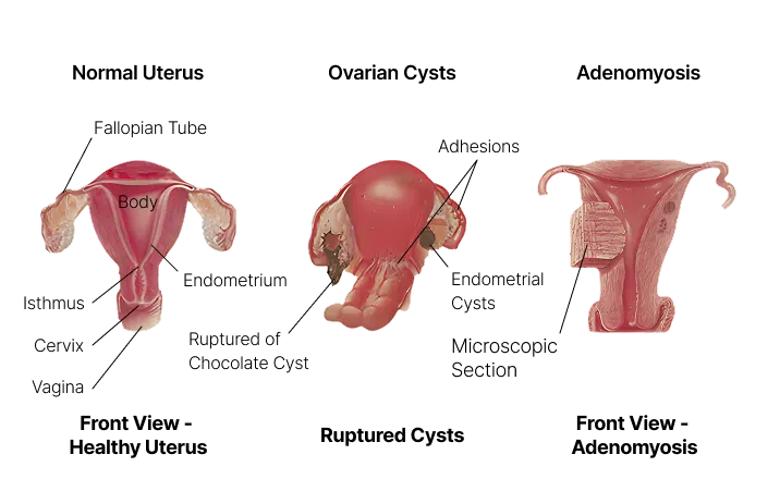 Diagram of a normal uterus vs. endometriotic cysts and adenomyosis.