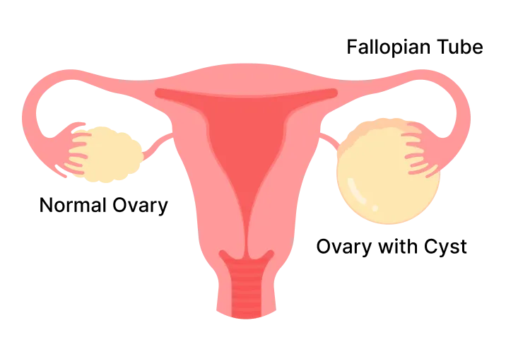 Ovarian Cysts in Singapore