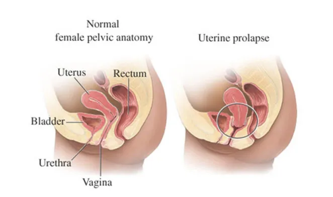 Medical diagram comparing normal female pelvic anatomy with uterine prolapse