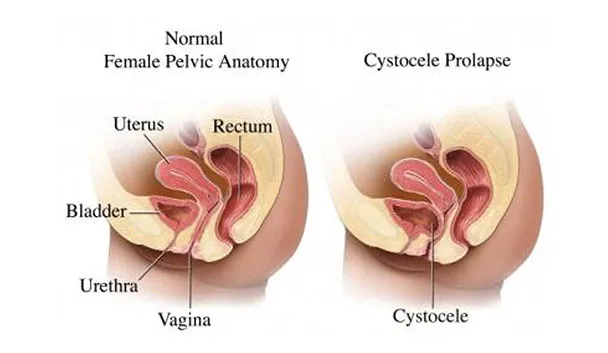 Medical diagram comparing normal female pelvic anatomy with a cystocele prolapse 