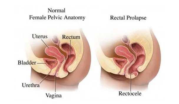 Medical diagram comparing normal female pelvic anatomy with a rectocele (rectal prolapse)