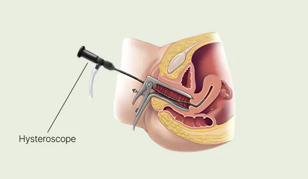 Medical diagram of a hysteroscopy showing a hysteroscope inserted into the uterus