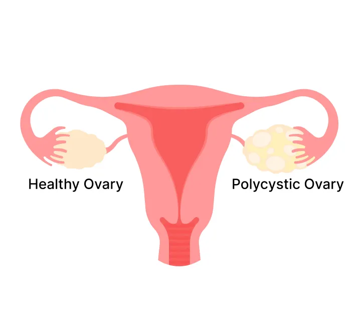 Diagram comparing a healthy ovary and a polycystic ovary