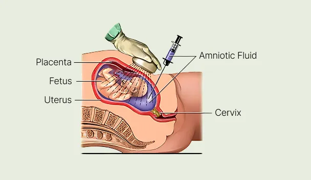 Medical diagram of an amniocentesis procedure showing a needle extracting amniotic fluid