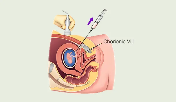Medical diagram of a chorionic villus sampling (CVS) procedure showing a needle sampling tissue from the chorionic villi