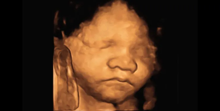 3D ultrasound scan showing a close-up of a fetus's face