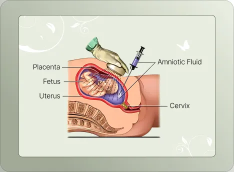 Diagram showing Amniocentesis and Chorionic Villus Sampling (CVS) procedures.